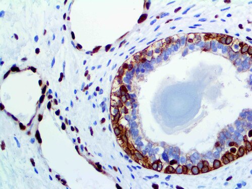 IHC of cytokeratin & ERG on an FFPE Prostate Tissue